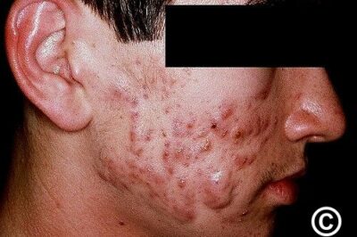 The miracle of healing acnes