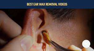 Full Video Ear Cleaning