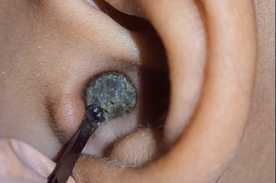 Full Video Ear Cleaning 2